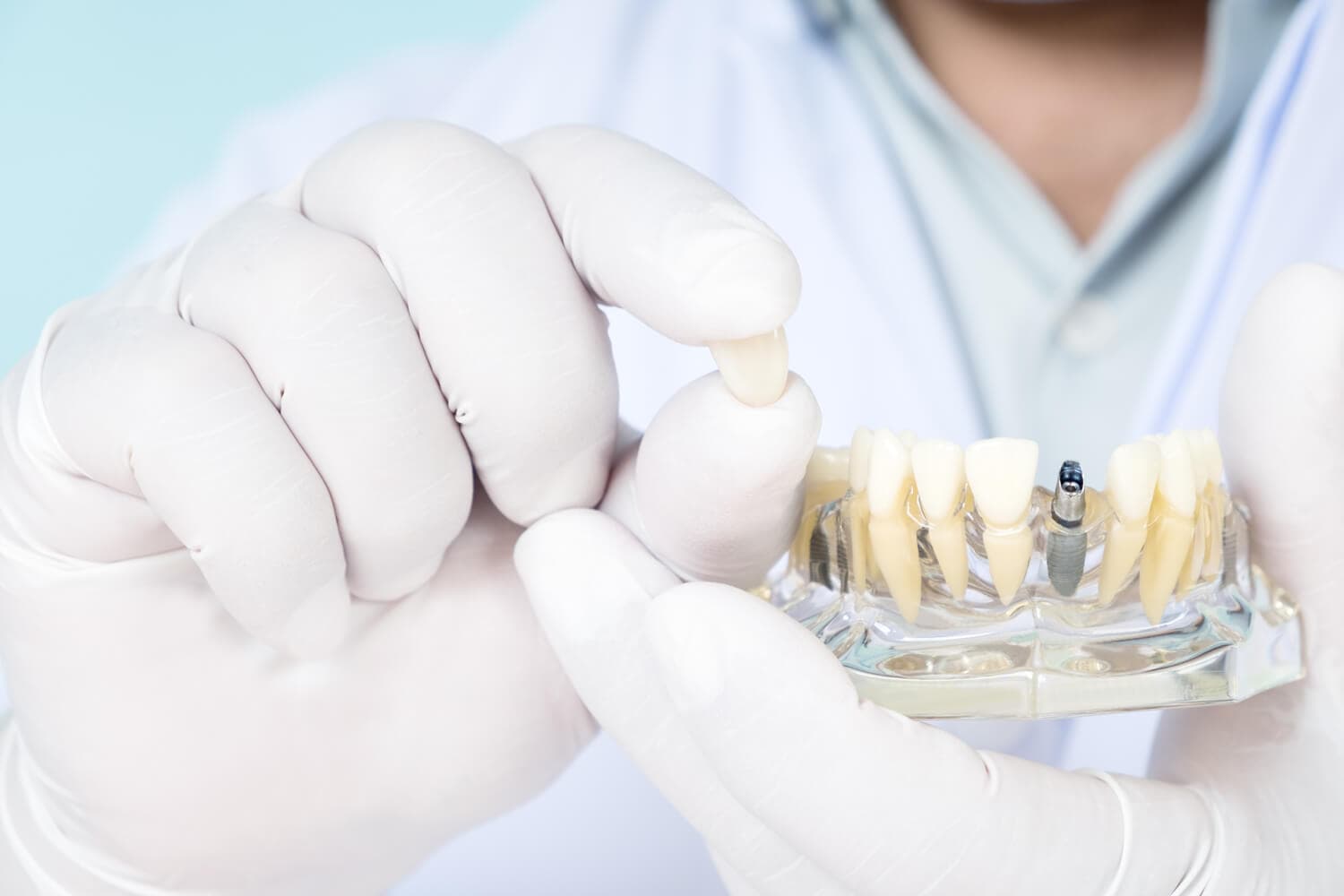Clínica Gómez y Alonso, implantes dentales en Teo