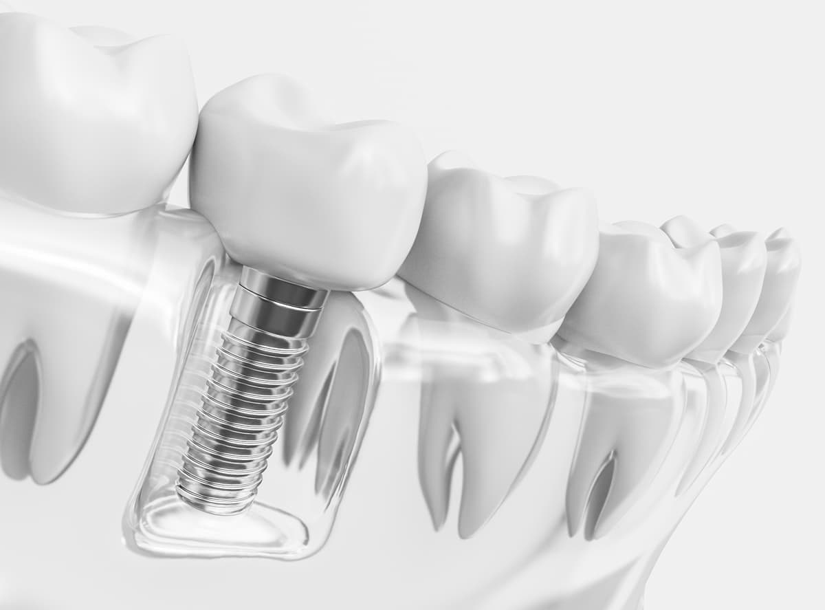 Implantes dentales en Teo